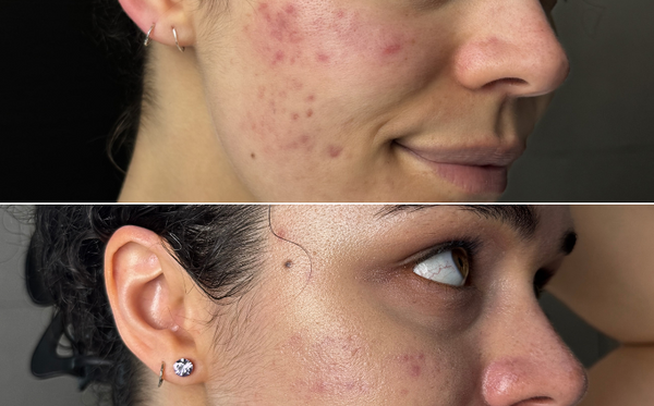 Red Light Therapy Before and After Image of Woman's Face