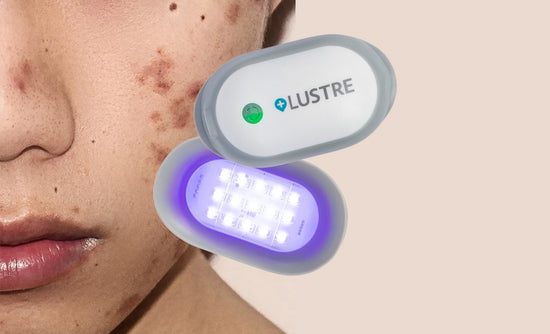 The acne fighting device that changed my life