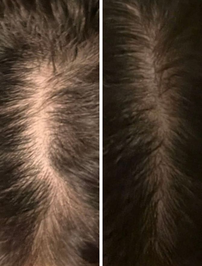 What Are The Main Causes Of Female Hair Loss? Everything You Need To Know