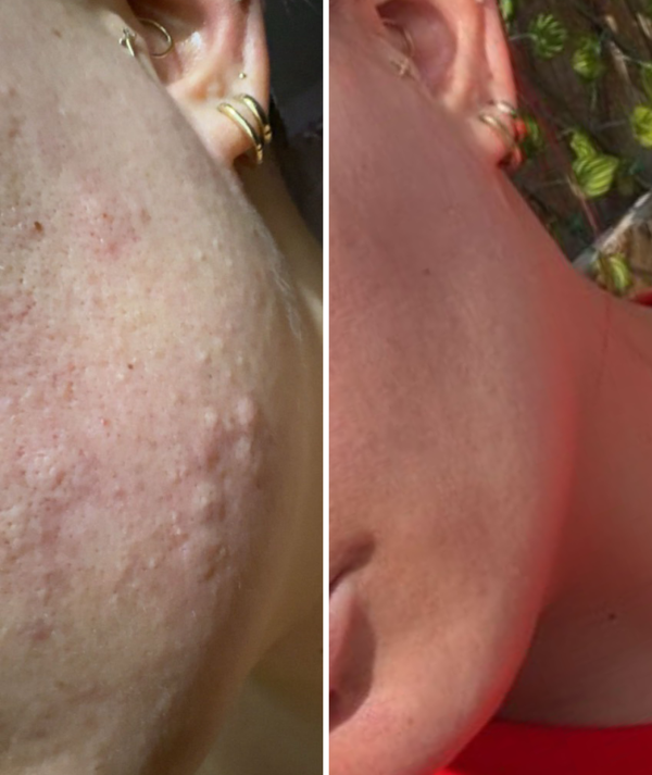 Breakouts & Spots