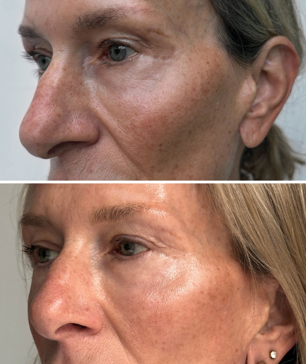 Pigmentation