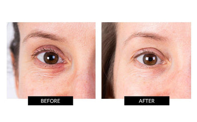 NIRA Precision Anti-Ageing Laser